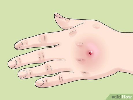 החיידק MRSA Staph