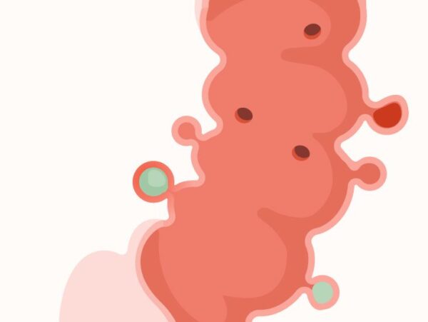 דיברטיקולום Herbal treatment of diverticulitis